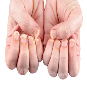 Abnormal Nail Symptoms and Causes